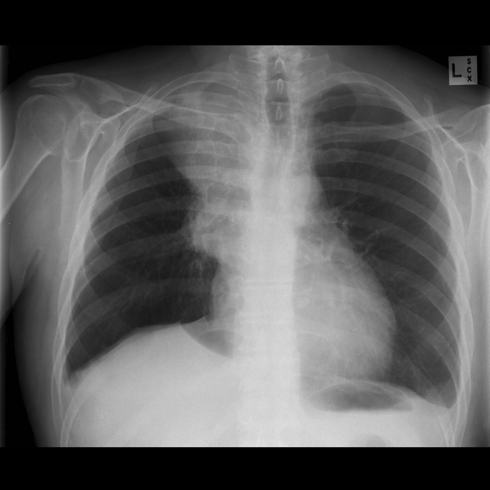 File:Small-cell-lung-cancer-right-upper-lobe-collapse.jpg
