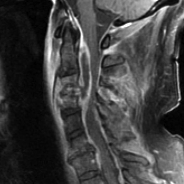 File:Spinal epidural abscess(MRI).jpg