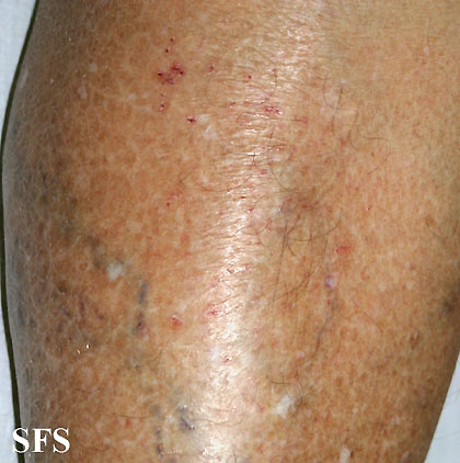 . Adapted from Dermatology Atlas.<ref name="Dermatology Atlas">{{Cite