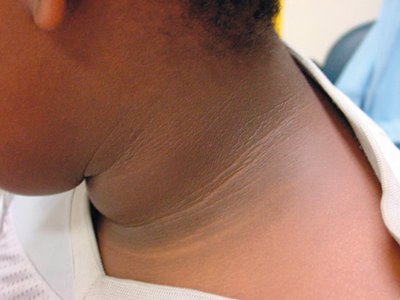 Acanthosis nigricans Adapted from [1]<ref name="www.atlasdermatologico.com.br">