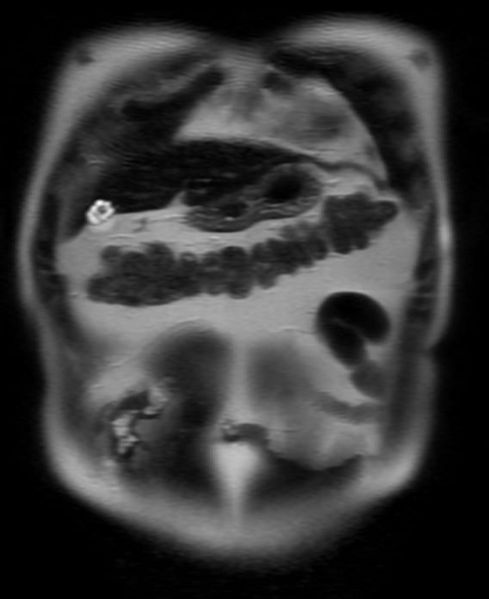 File:Adenomyomatosis MRI 001.jpg
