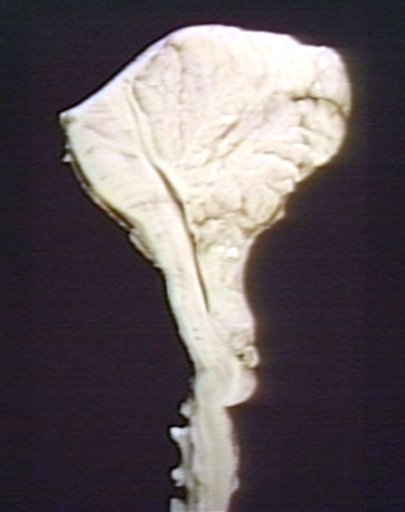 Brain: Arnold Chiari Malformation; Note Z-Shaped Kink in Cervical Spinal Cord