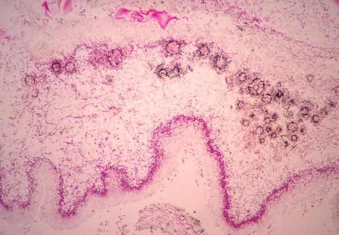 This micrograph depicts the histopathologic features of aspergillosis including the presence of conidia-laden conidiophores. From Public Health Image Library (PHIL). [1]