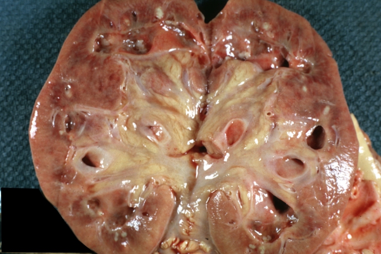 Kidney: Papillary Necrosis: Gross, yellow foci in pyramids, a gout kidney