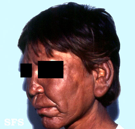 File:Lepromatous leprosy17.jpg