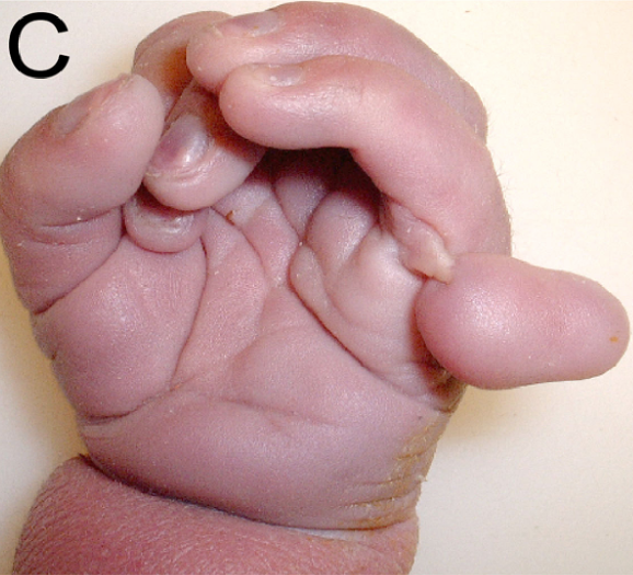 A 37 2/7 week gestational age male infant with Patau syndrome demonstrating polydactyly