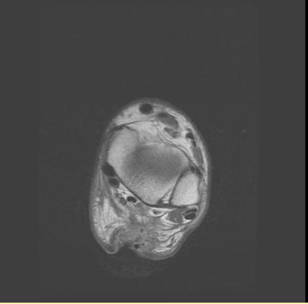Proton density: MRI; Achilles tendon rupture