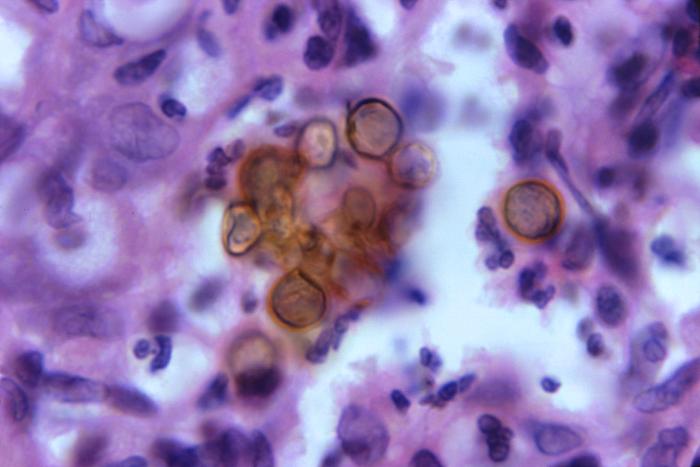 Magnified 1188X, this H&E-stained photomicrograph revealed histopathologic changes, which were indicative of the chronic fungal disease process known as chromoblastomycosis, or chromomycosis. The tissue sample was harvested from an Indian patient. Predominantly, this infection affects the skin, or cutaneous tissues, and usually begins at the site of a puncture wound, which introduces the pathologic fungal organism into the recipient’s tissues. From Public Health Image Library (PHIL). [2]