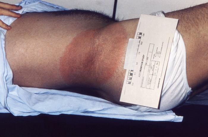 Right hip and waist region of a patient who’d presented with the erythema migrans (EM) rash characteristic of what was diagnosed as Lyme disease. From Public Health Image Library (PHIL). [1]