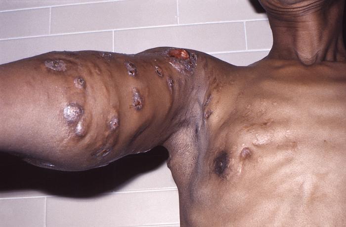 Anterior perspective of patient with nocardiosis infection of his right upper arm due to Gram-positive Nocardia brasiliensis bacteria. From Public Health Image Library (PHIL). [6]