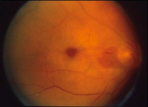 Cherry Red Spot. Baby: Tay-Sachs. Adult: Central retinal artery occlusion (sudden painless unilateral vision loss) HTN, DM, Leukemia. [3]
