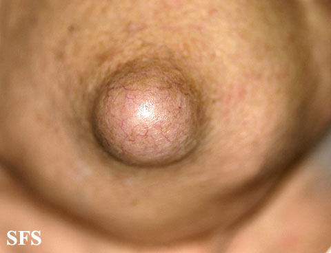 Epidermoid cyst. Adapted from Dermatology Atlas.[4]