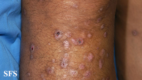 File:Epidermolysis bullosa pruriginosa28.jpg