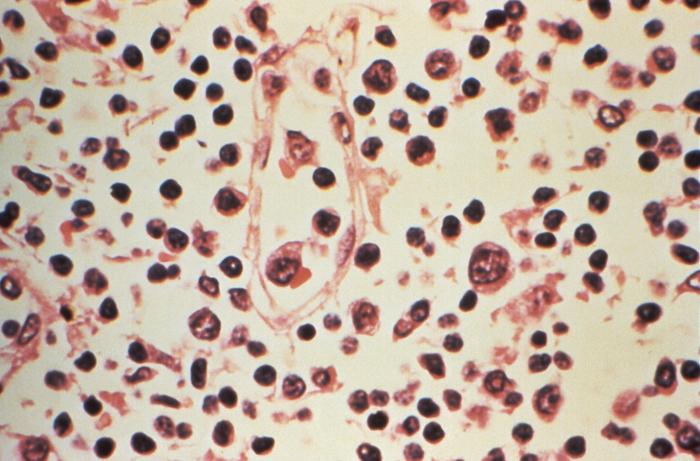 Image reveals some of the cytoarchitectural features seen in a lymph node specimen that had been extracted from a patient suspected of a Hantavirus illness. From Public Health Image Library (PHIL). [1]