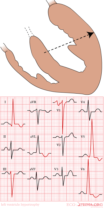 Left ventricular hypertrophy; left ventricular strain due to aortic stenosis.