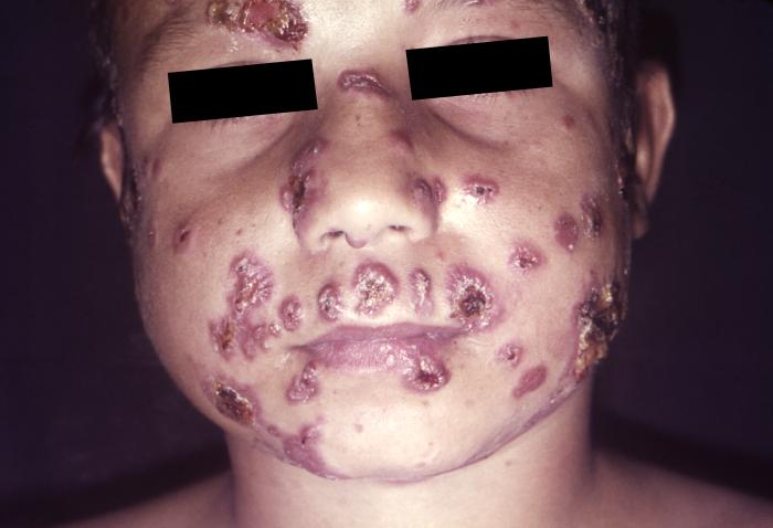 This image from 1965 depicted an anterior view of a Sao Paulo, Brazilian child’s face that displayed the ravages of the mycotic infection, paracoccidioidomycosis.[10]