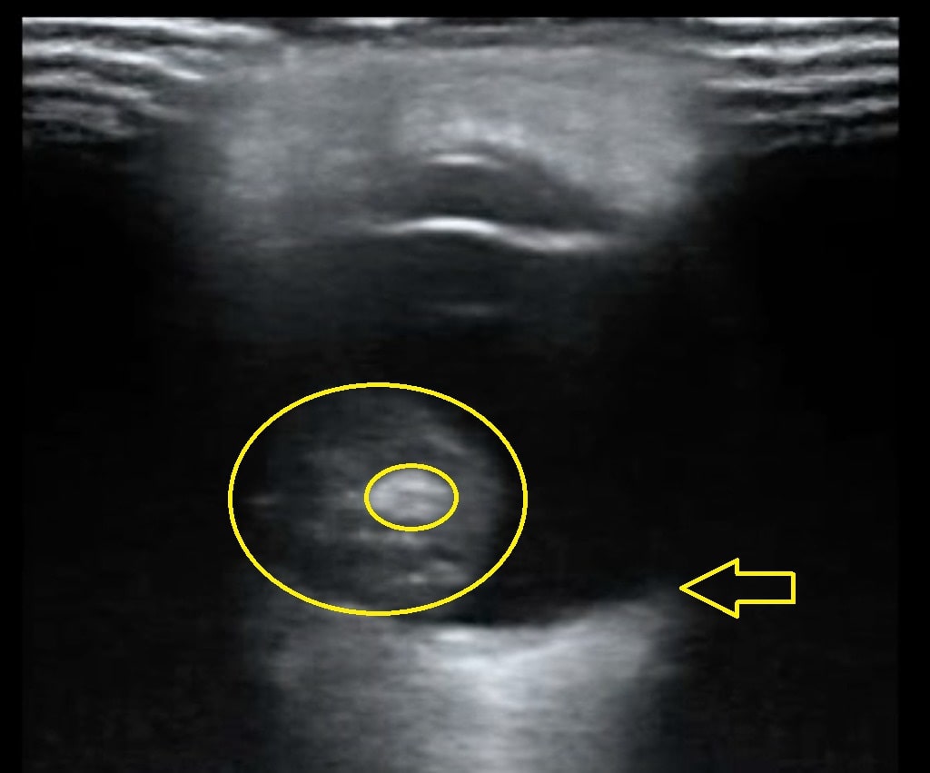 File:Retinoblastoma-Ultra.jpg