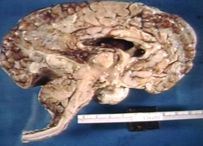 Brain: Arnold Chiari Malformation; Meningomyelocele, Type II, Meningitis