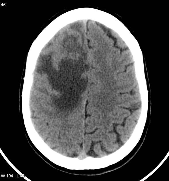 Ct scan without contrast of the patient with known metastatic breast cancer, complaining of headache, demonstrates a solitary right frontal lobe mass with extensive surrounding edema. The mass has it's epicenter close to the grey white matter junction.[4]