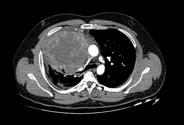 CT shows a mediastinal germ cell tumor.