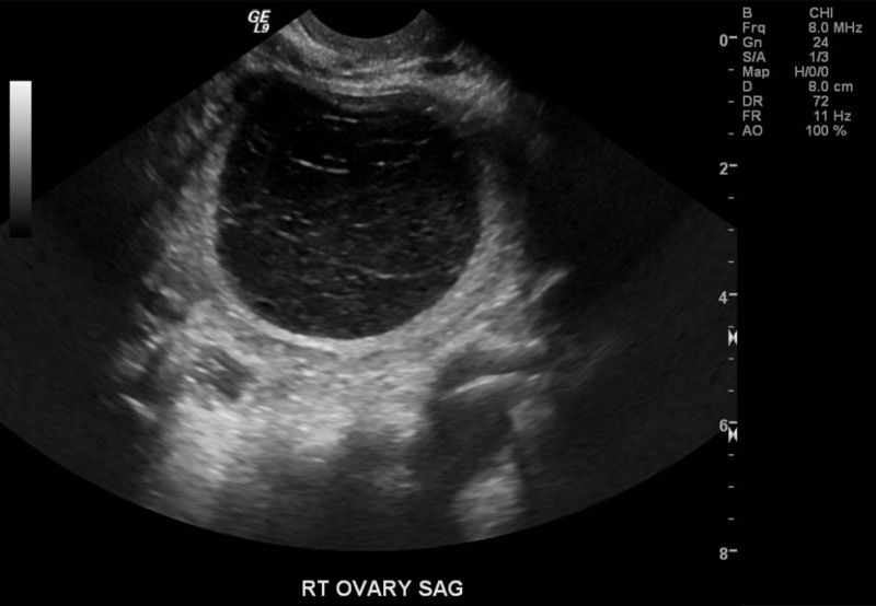 File:Hemorrhagic ovarian cyst ultrasound 101.jpg