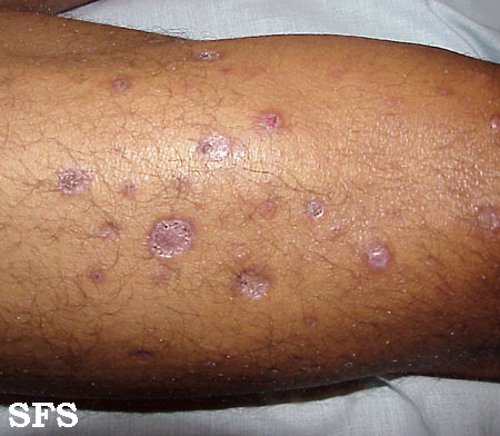 File:Lepromatous leprosy30.jpg