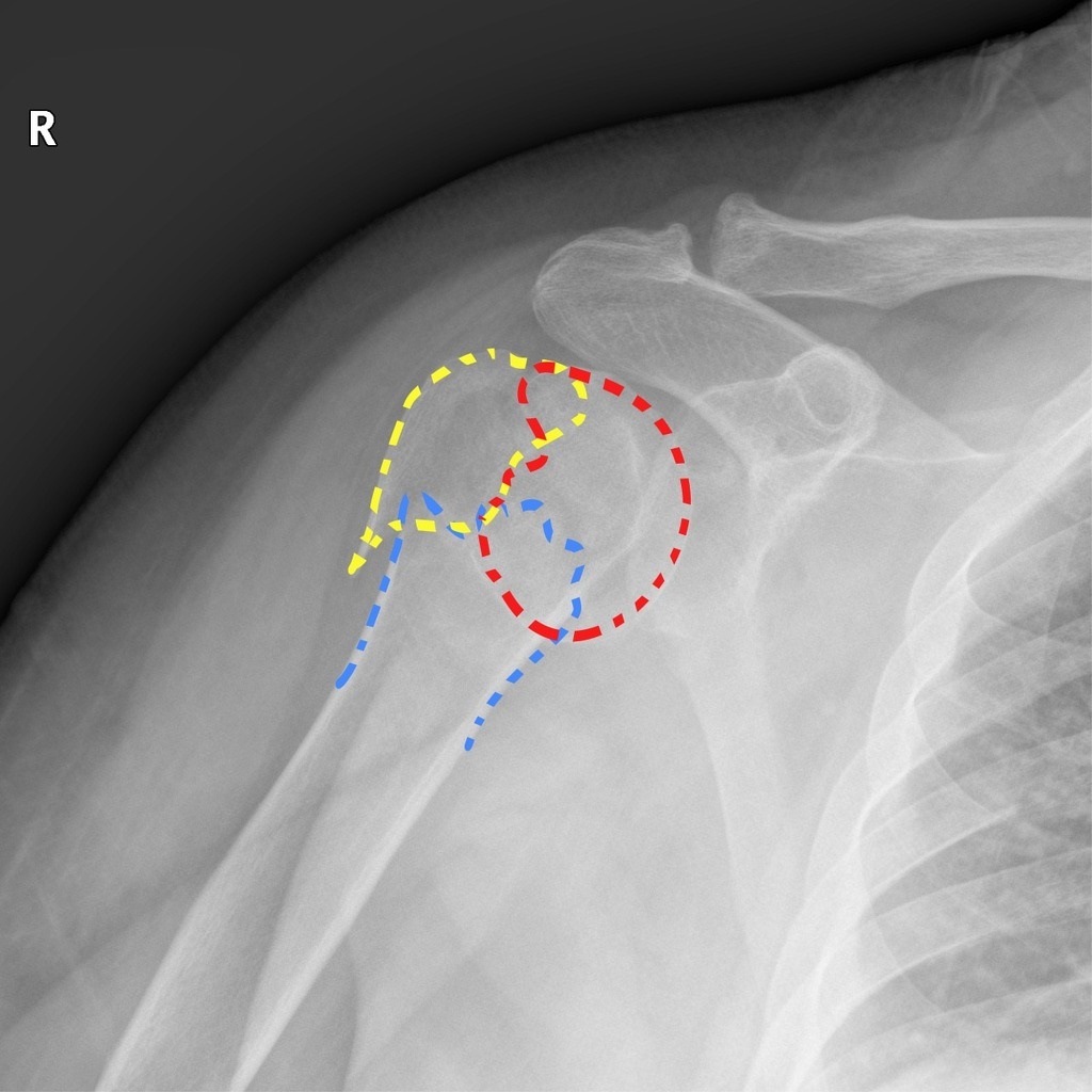 File:Proximal-humeral-fracture.jpg