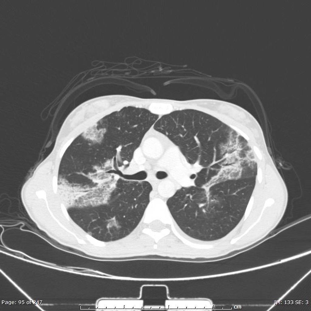 File:Acute-eosinophilic-pneumonia.jpg