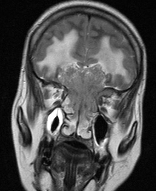 File:Coronal T1 esthesioneuroblastoma.jpg