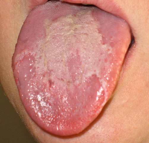 Human geographic tongue.jpg