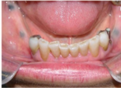 Oral Melanthocoma.png