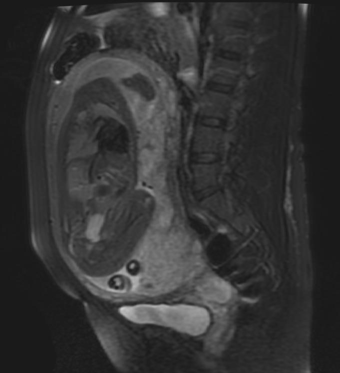 File:Placenta previa MRI 001.jpg