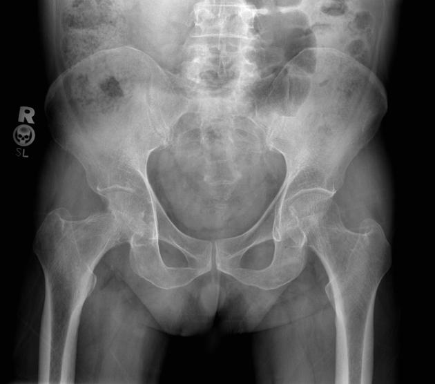File:Tuberculosis Arthritis X-ray.jpg