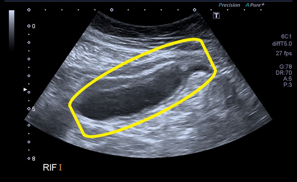 File:Appendix-mucocele.jpg