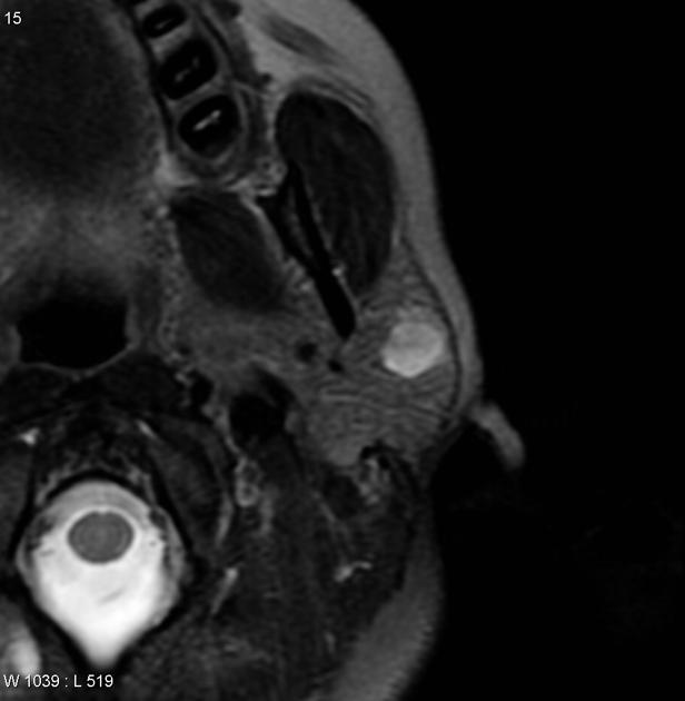 MRI showing Axial T2 parotid adenocarcinoma[5]