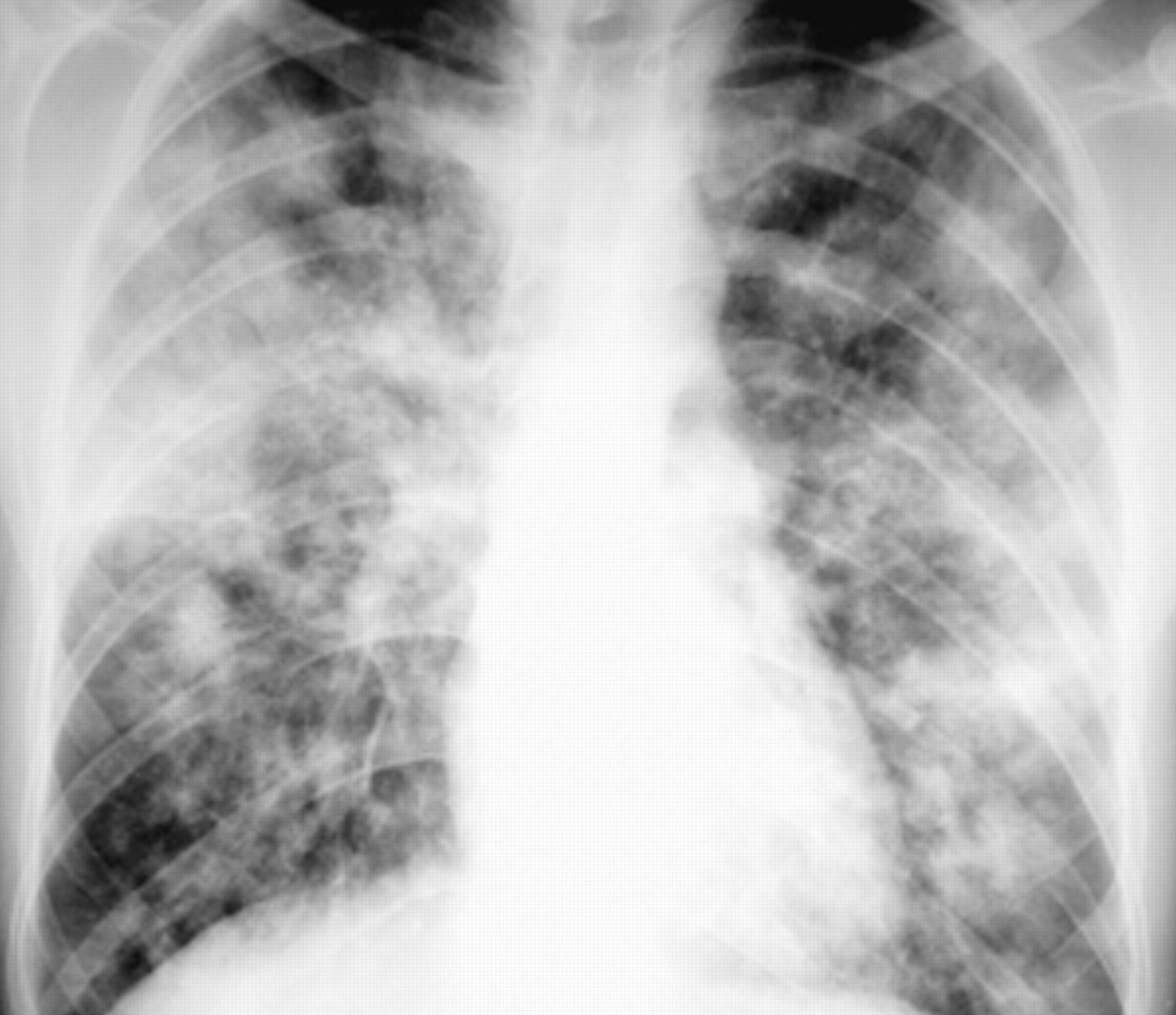 File:Bronchopneumonia caused by aspergillus.jpg