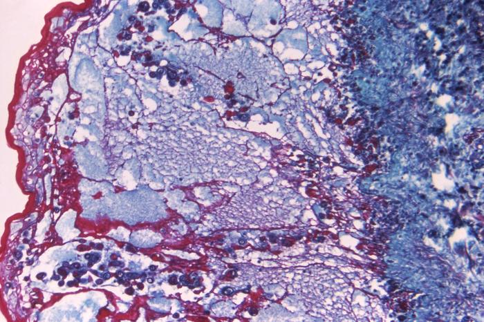 Cytoarchitectural histopathologic changes which you’d find in a human skin tissue specimen that included a chickenpox (125x mag). From Public Health Image Library (PHIL). [1]