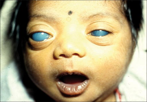 File:Congenital glaucoma.PNG