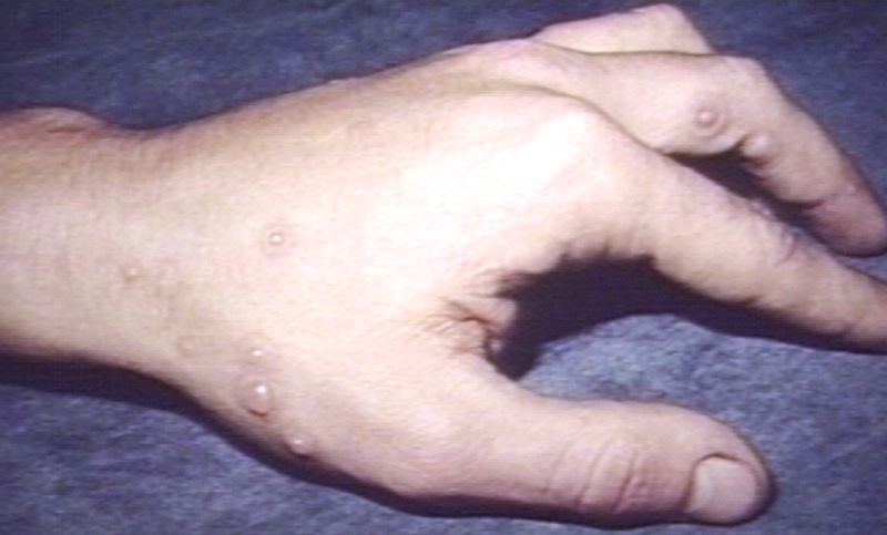 Skin: Erythema Multiforme, Vesicular; Vesiculobullous Diseases