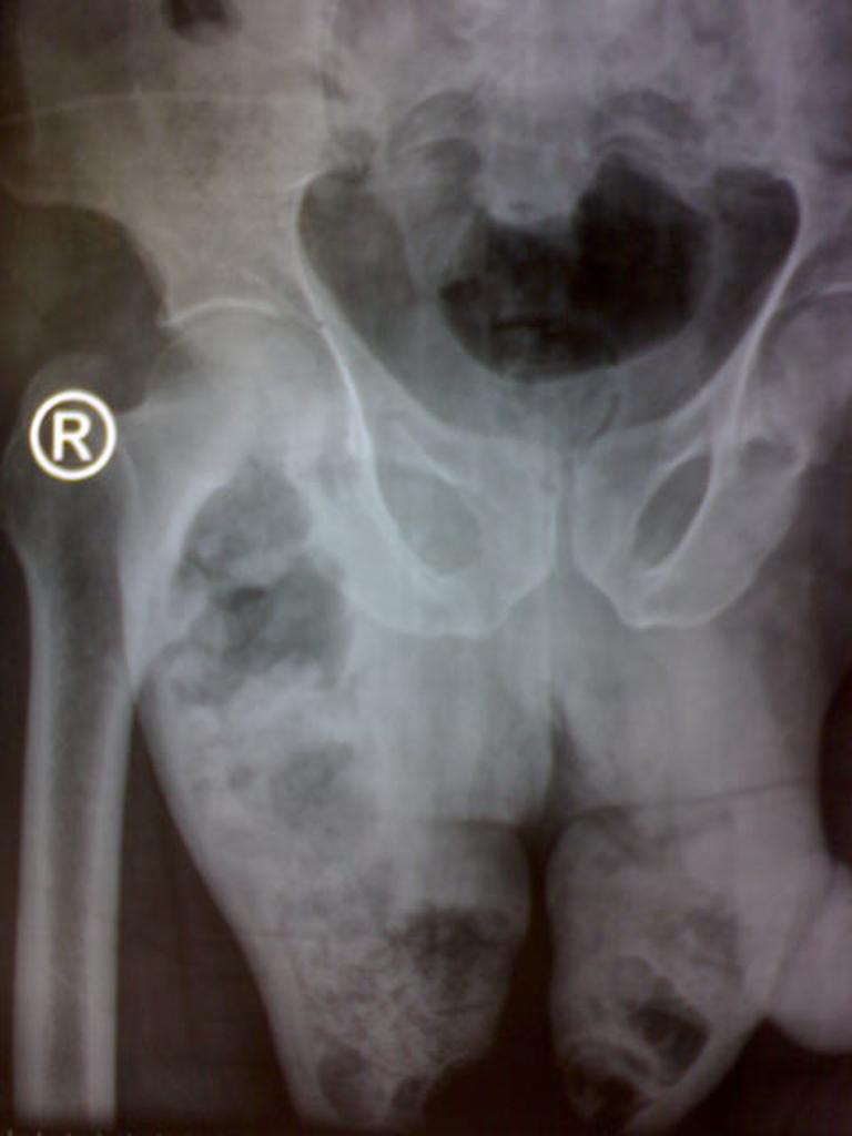 X ray of Fournier's gangrene [19]