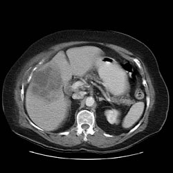Diagnostic considerations here would include, first, a locally invasive gallbladder adenocarcinoma and second, an occult colon carcinoma.