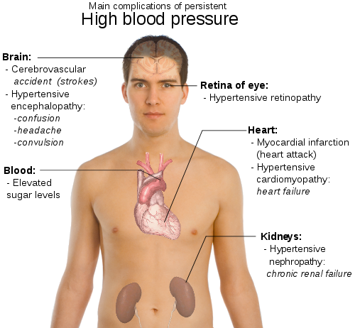File:Main complications of persistent high blood pressure.svg.png