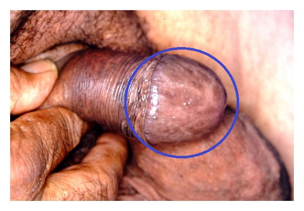 File:Penile lentigines in BRRS .jpg