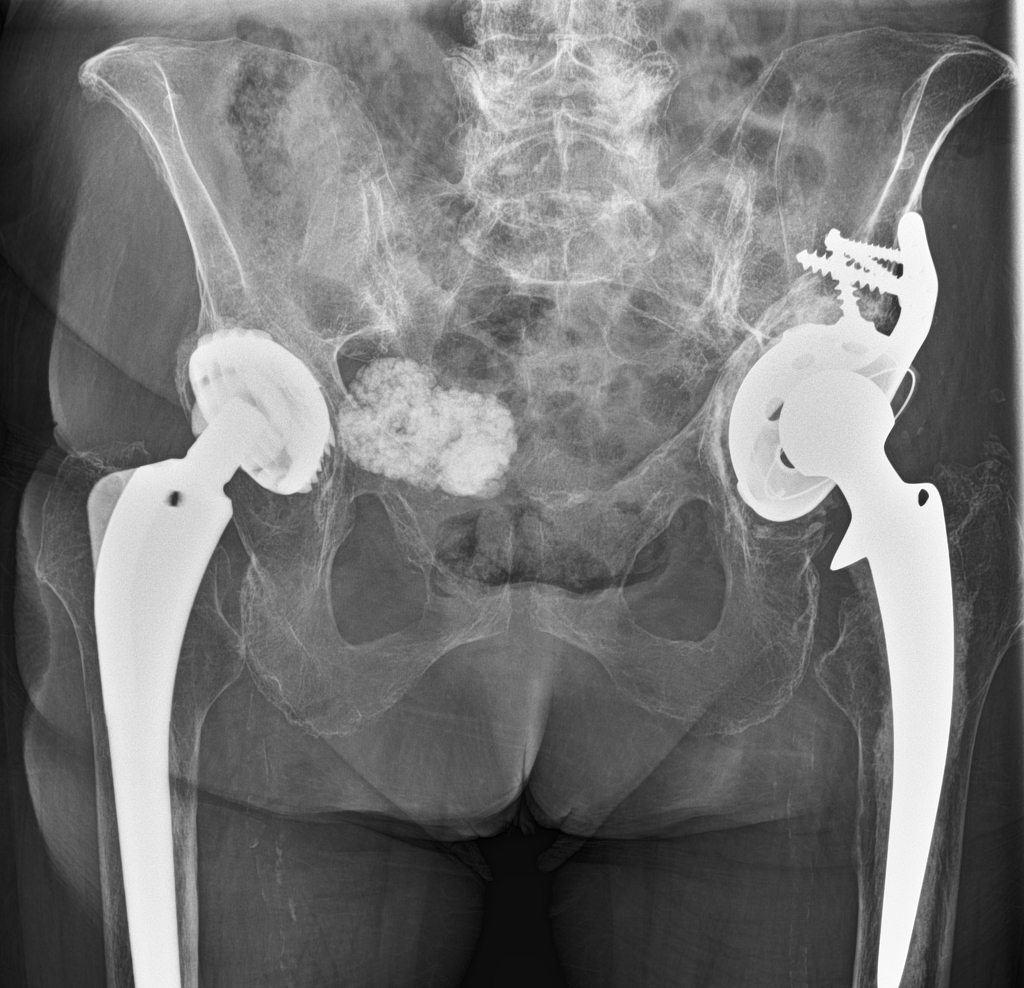 A minimally displaced periprosthetic fracture is visible around the lateral aspect of the stem of the prosthesis, corresponding to a Vancouver B1 fracture (see key image). Porotic bone structure. Incidentally an inhomogenous calcified mass is visible in the pelvis.