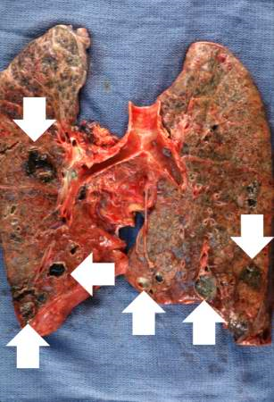 Gross photograph of the lung abscess. Note the abscesses (arrows) especially in the lower lobes.[8]