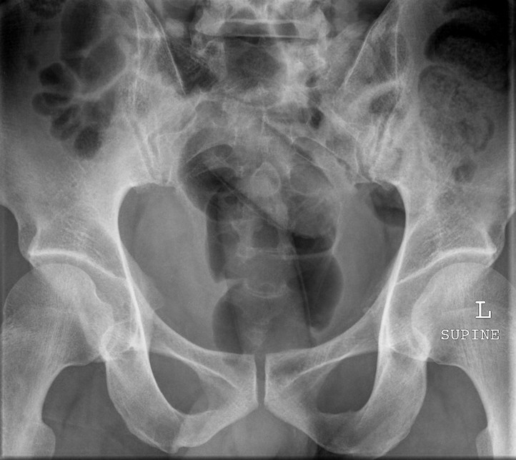 Rectal foreign body. Body packer. (Image courtesy of Dr Frank Gaillard)