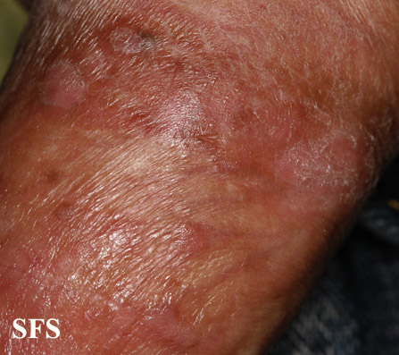 Bowenoid papulosis. Adapted from Dermatology Atlas.[3]