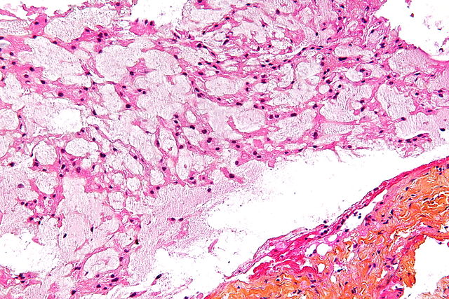 Micrograph showing a chordoma. HPS stain.[5]