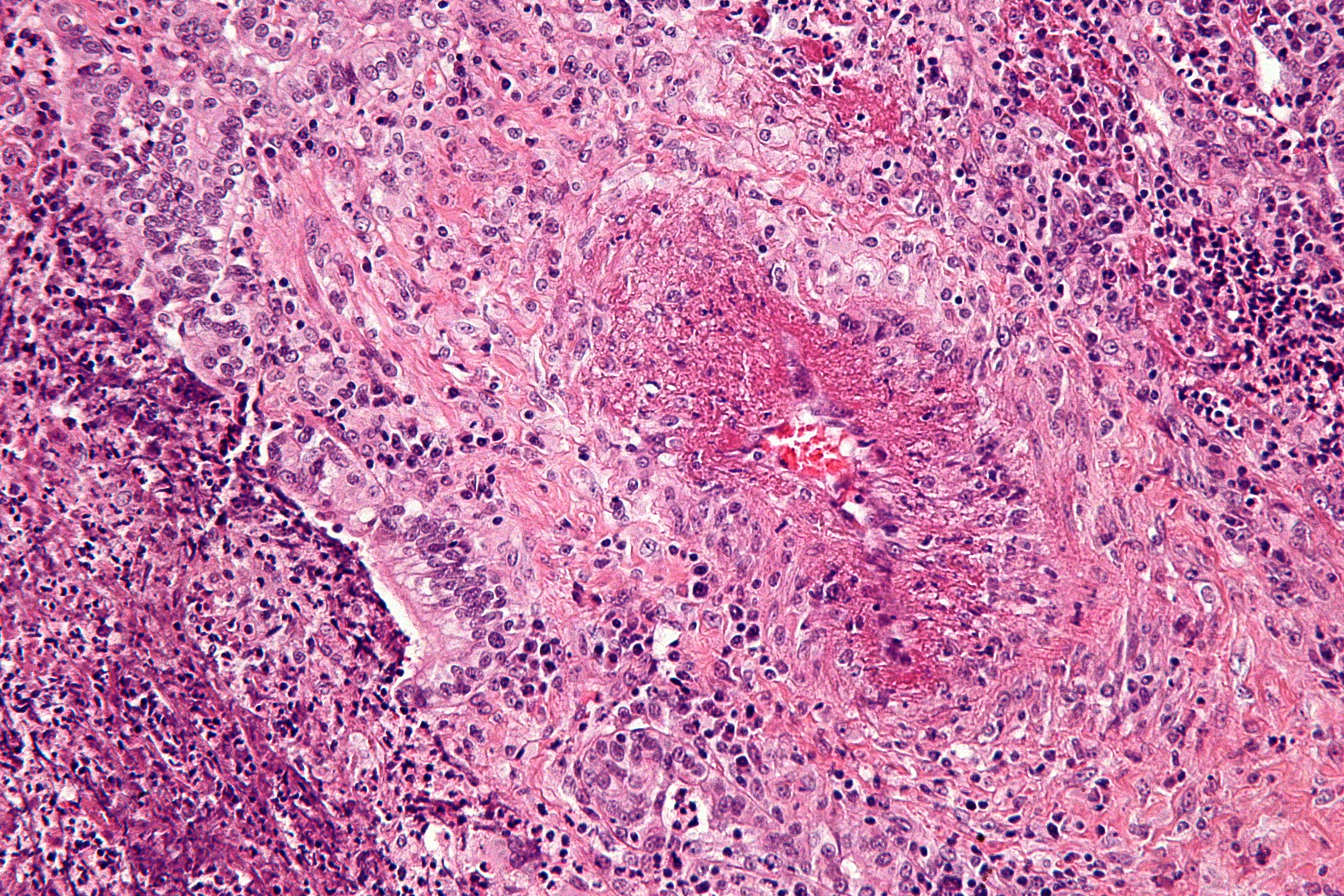 File:Granulomatosis with polyangiitis.jpg