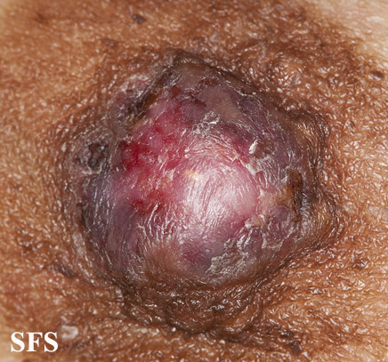 Paget's disease. Adapted from Dermatology Atlas.[3]